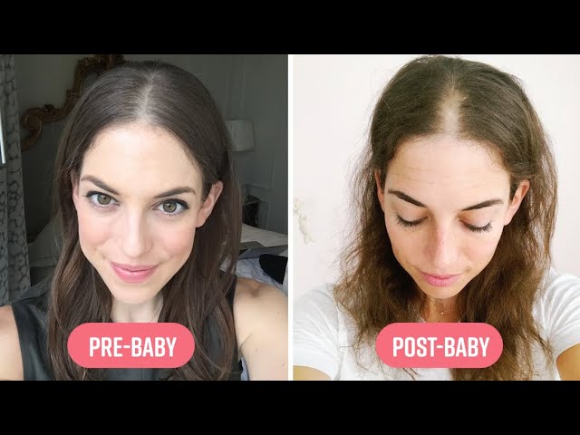 Is it possible to avoid hair loss after childbirth?